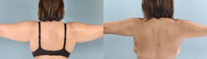 Before & After Liposuction Case 2766 View 1 View in Houston, TX