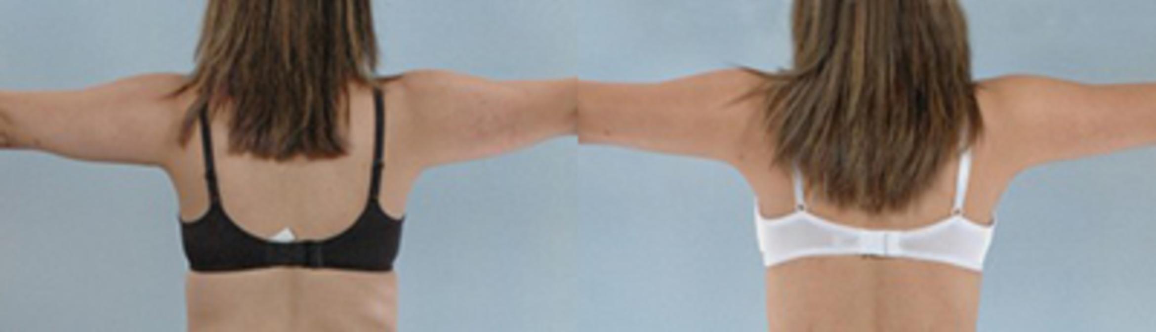 Before & After Liposuction Case 2770 View 1 View in Houston, TX