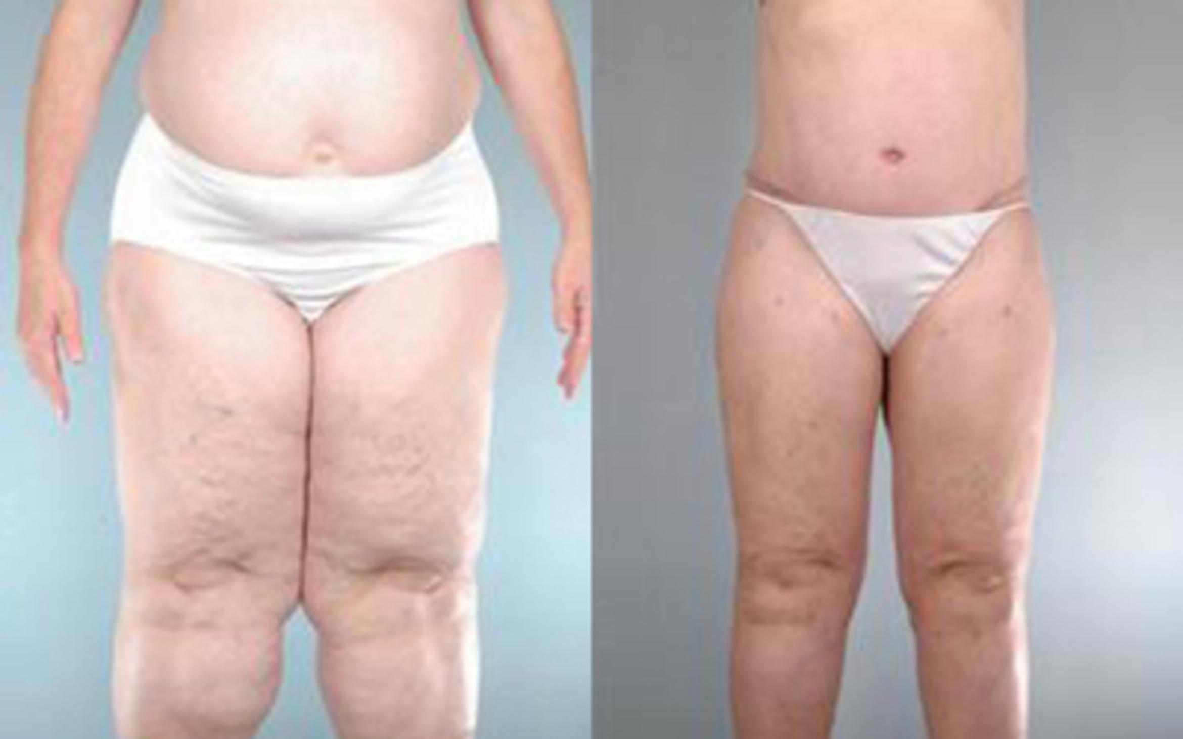 Before & After Liposuction Case 2774 View 1 View in Houston, TX