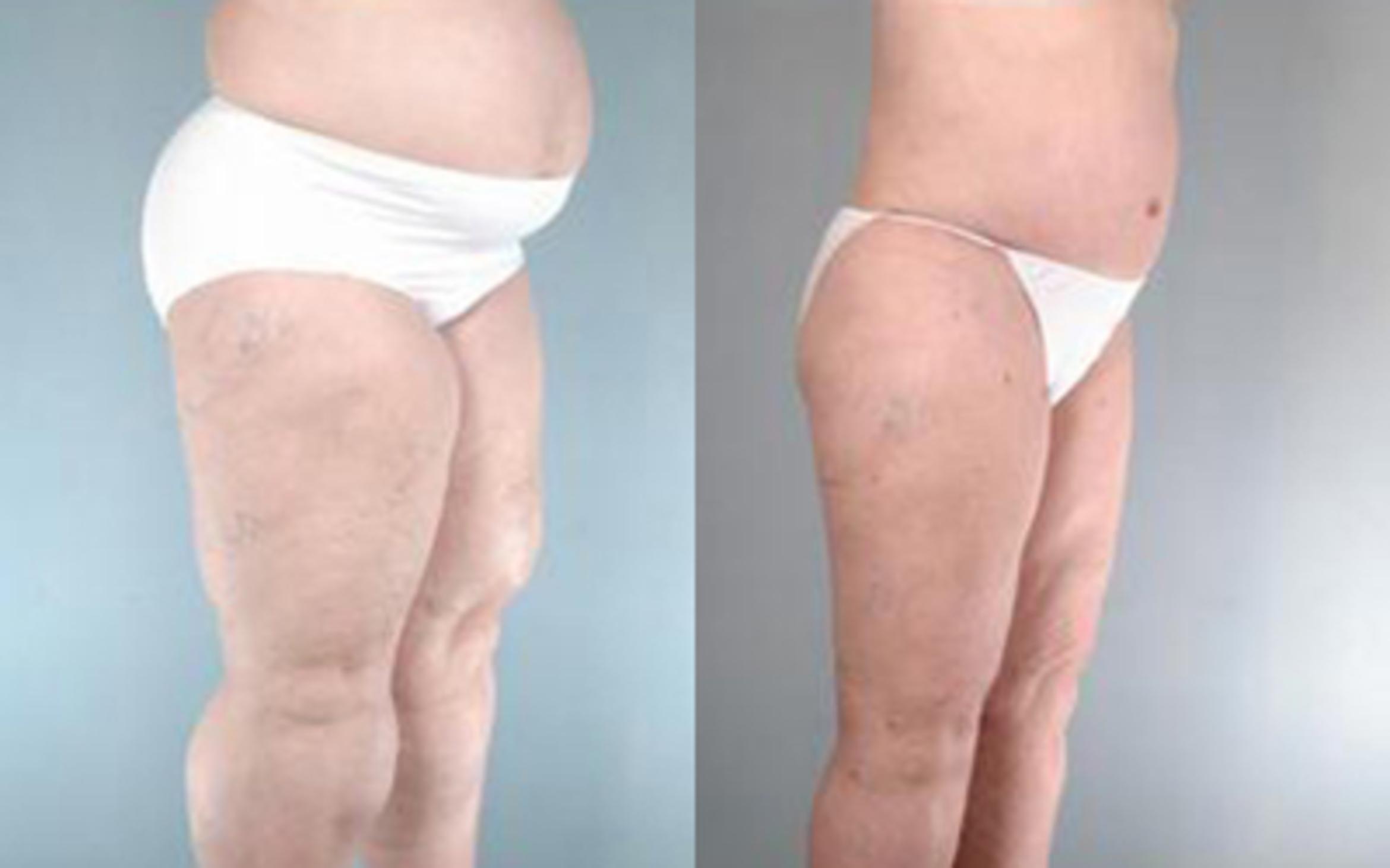 Before & After Liposuction Case 2774 View 2 View in Houston, TX