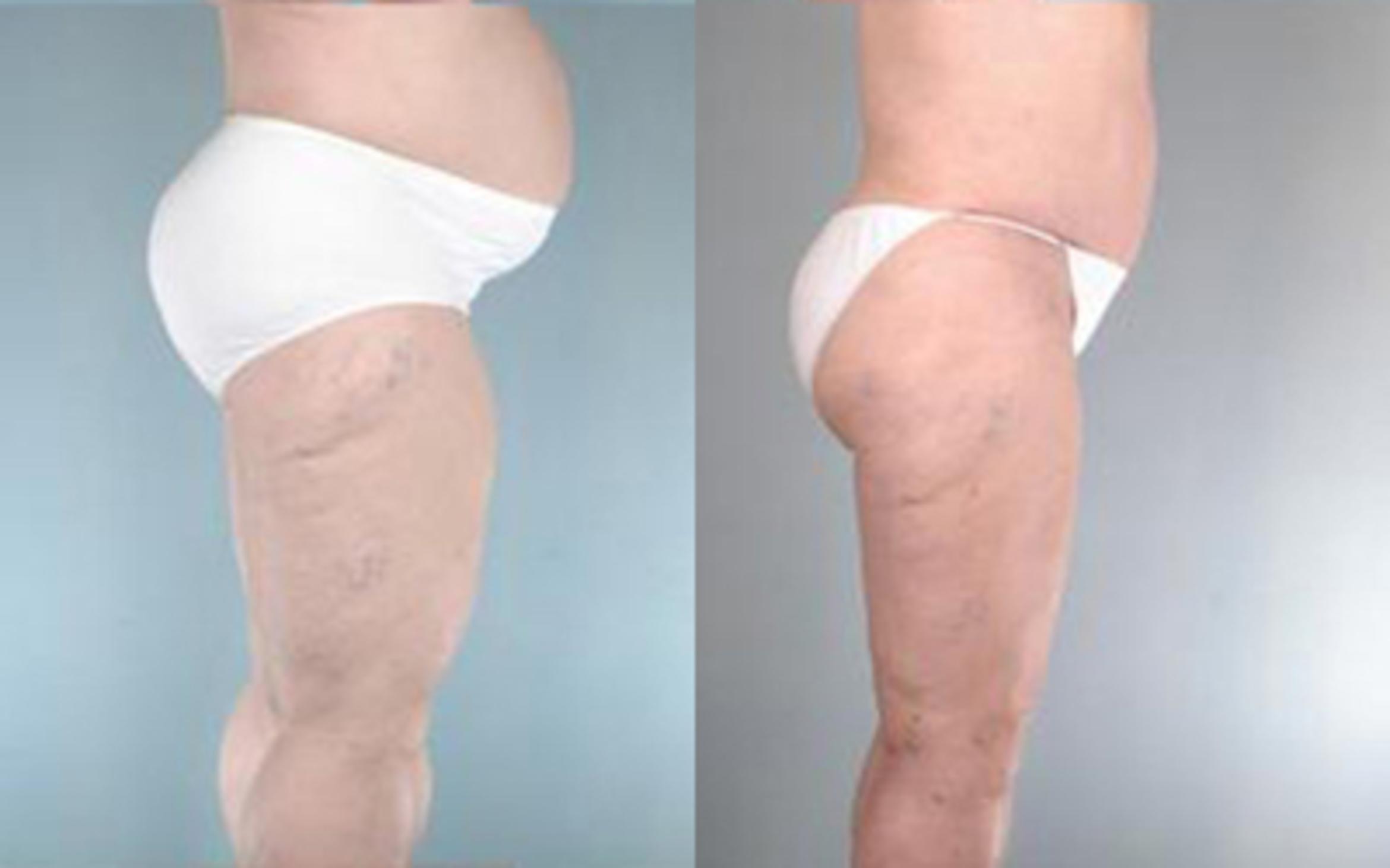 Before & After Liposuction Case 2774 View 3 View in Houston, TX