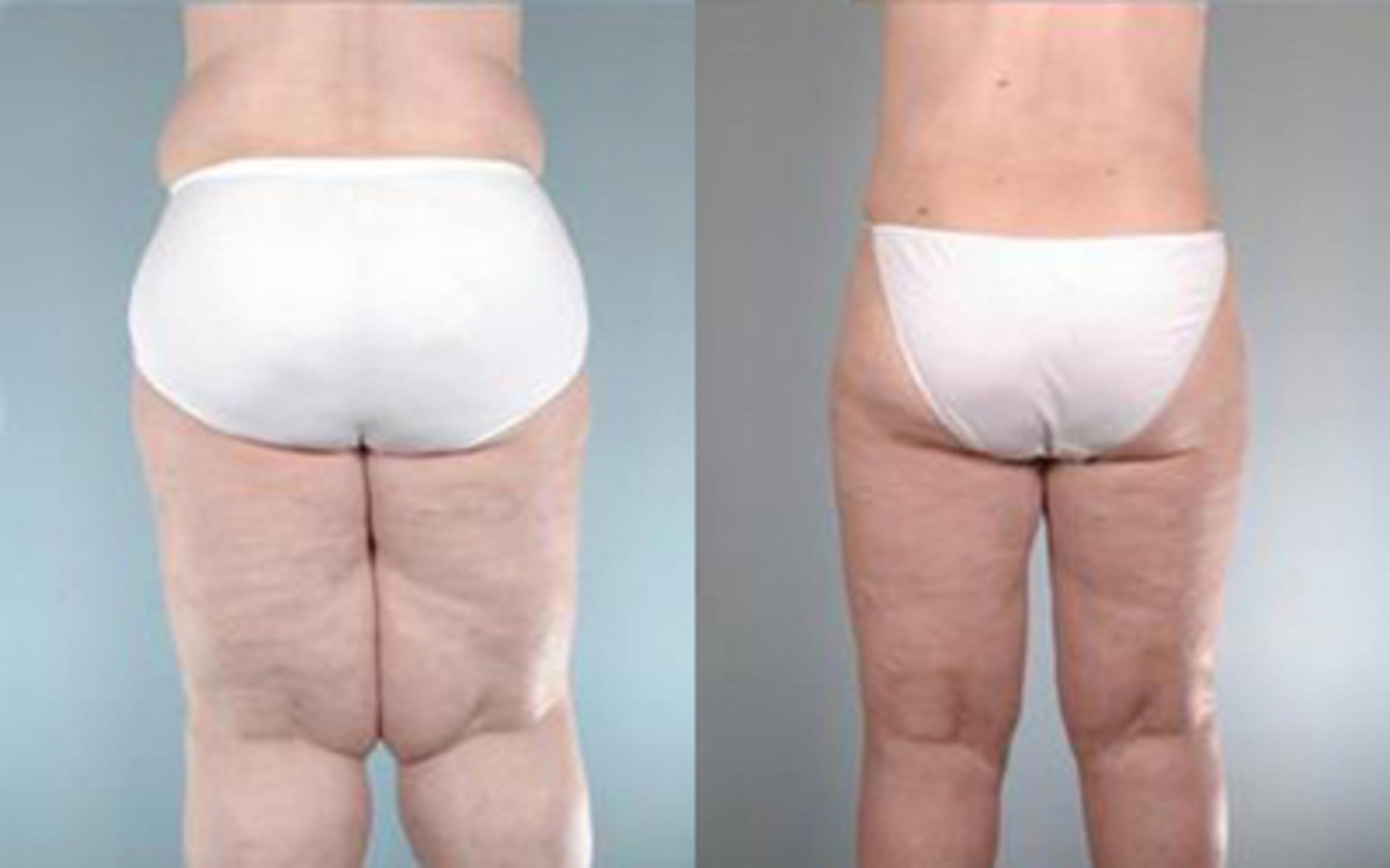 Before & After Liposuction Case 2774 View 4 View in Houston, TX