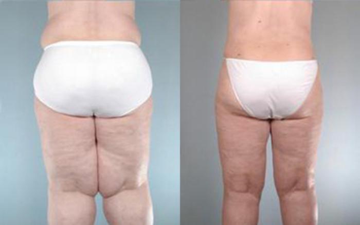 Before & After Liposuction Case 2774 View 4 View in Houston, TX