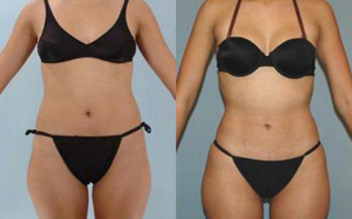 Before & After Liposuction Case 3195 View 1 View in Houston, TX