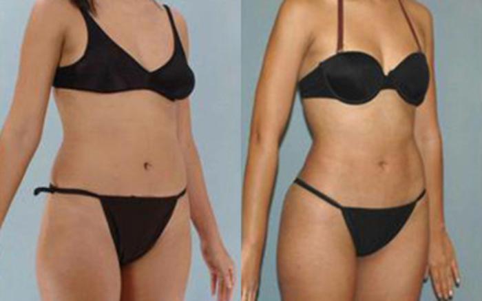Before & After Liposuction Case 3195 View 2 View in Houston, TX