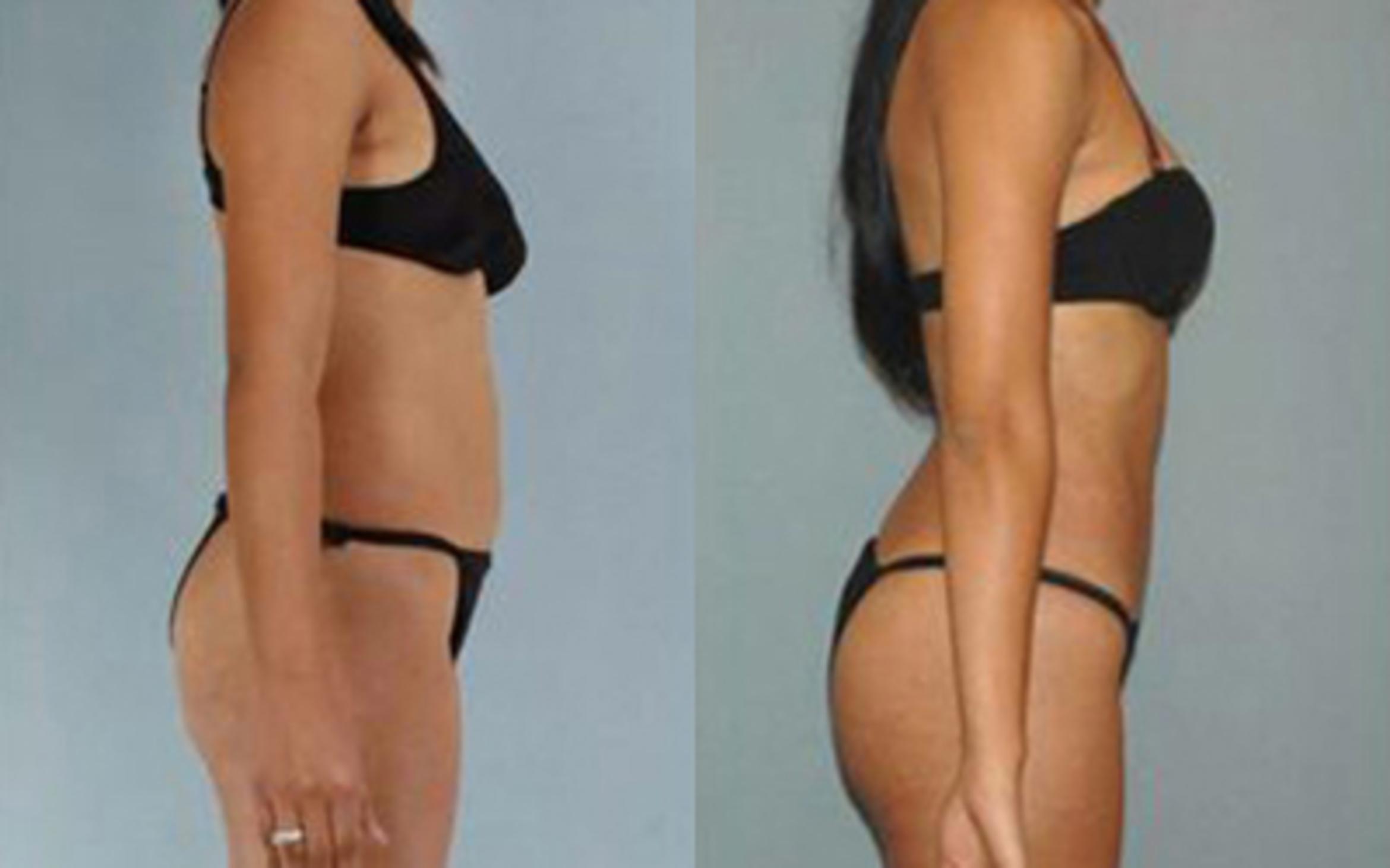 Before & After Liposuction Case 3195 View 3 View in Houston, TX