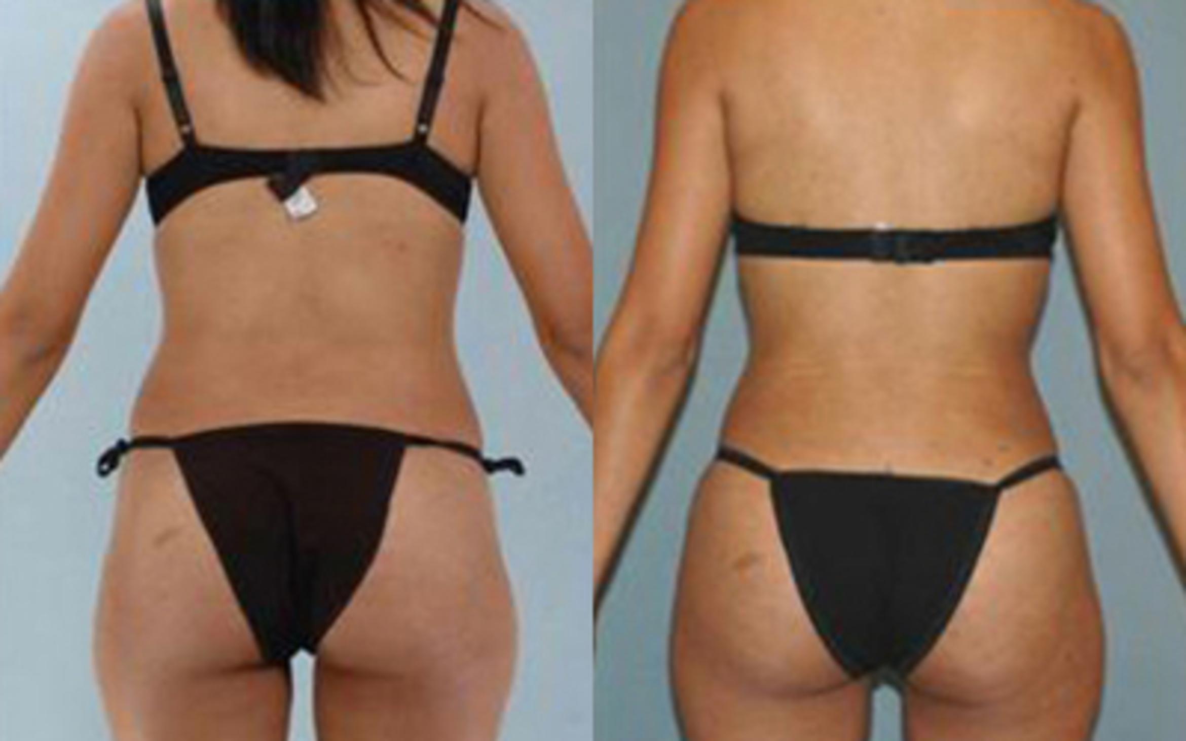 Before & After Liposuction Case 3195 View 4 View in Houston, TX