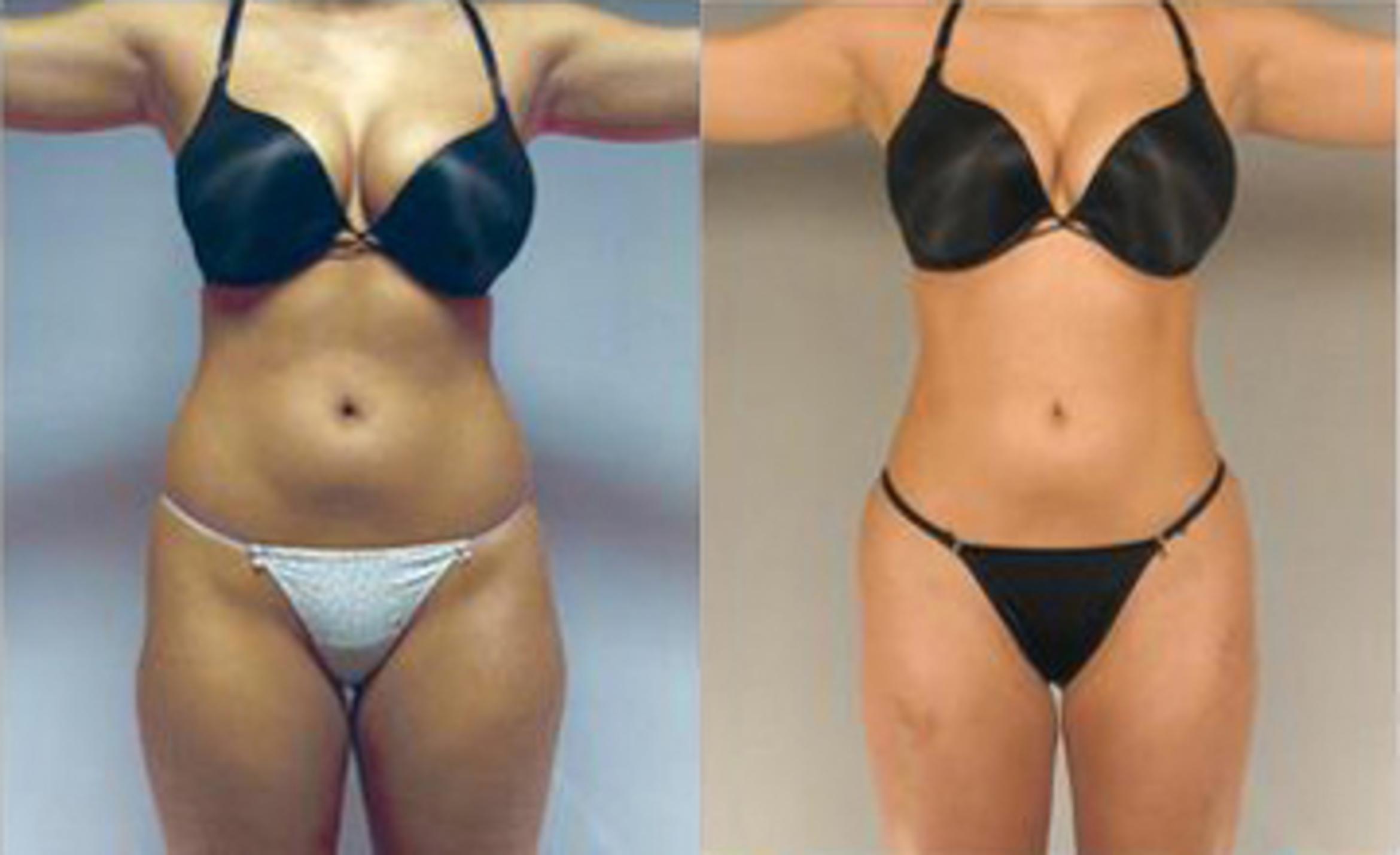 Before & After Liposuction Case 3205 View 1 View in Houston, TX