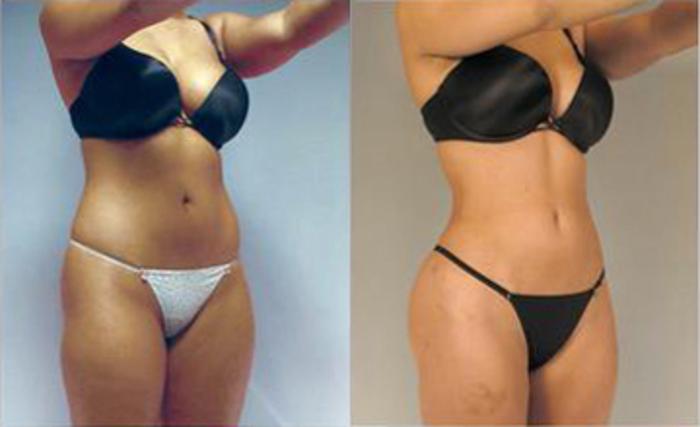 Before & After Liposuction Case 3205 View 2 View in Houston, TX