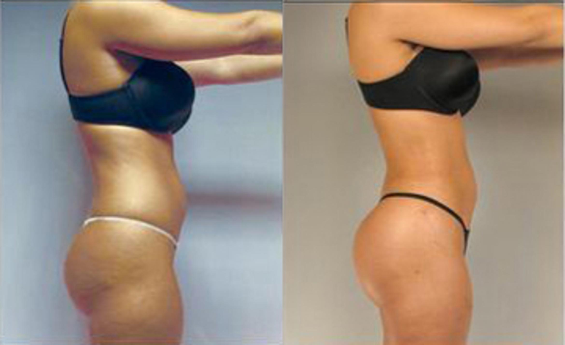 Before & After Liposuction Case 3205 View 3 View in Houston, TX