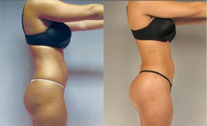 Before & After Liposuction Case 3205 View 3 View in Houston, TX