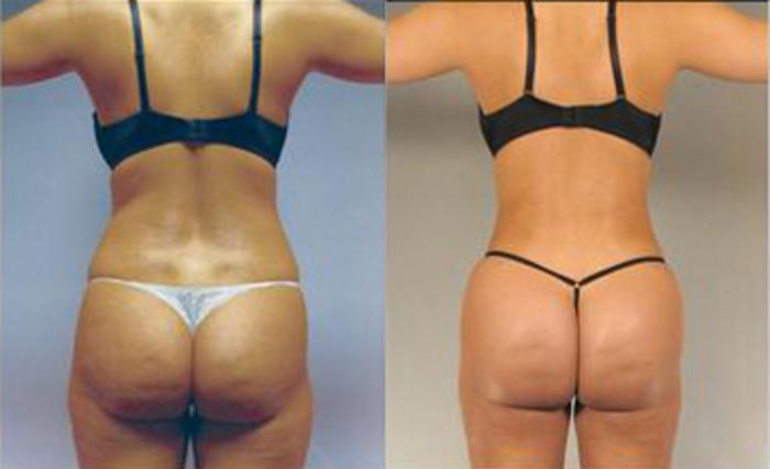 Before & After Liposuction Case 3205 View 4 View in Houston, TX