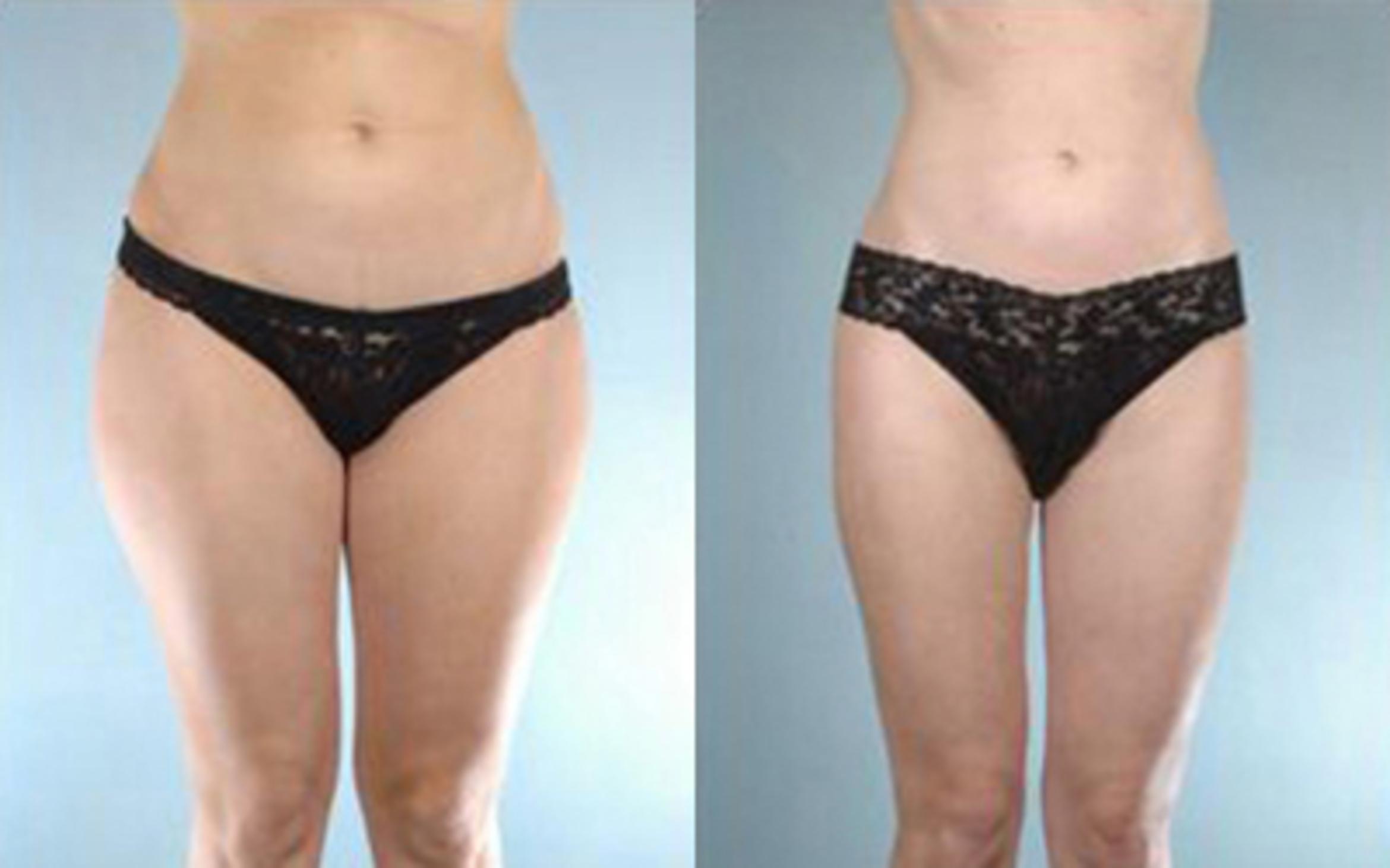 Before & After Liposuction Case 3215 View 1 View in Houston, TX