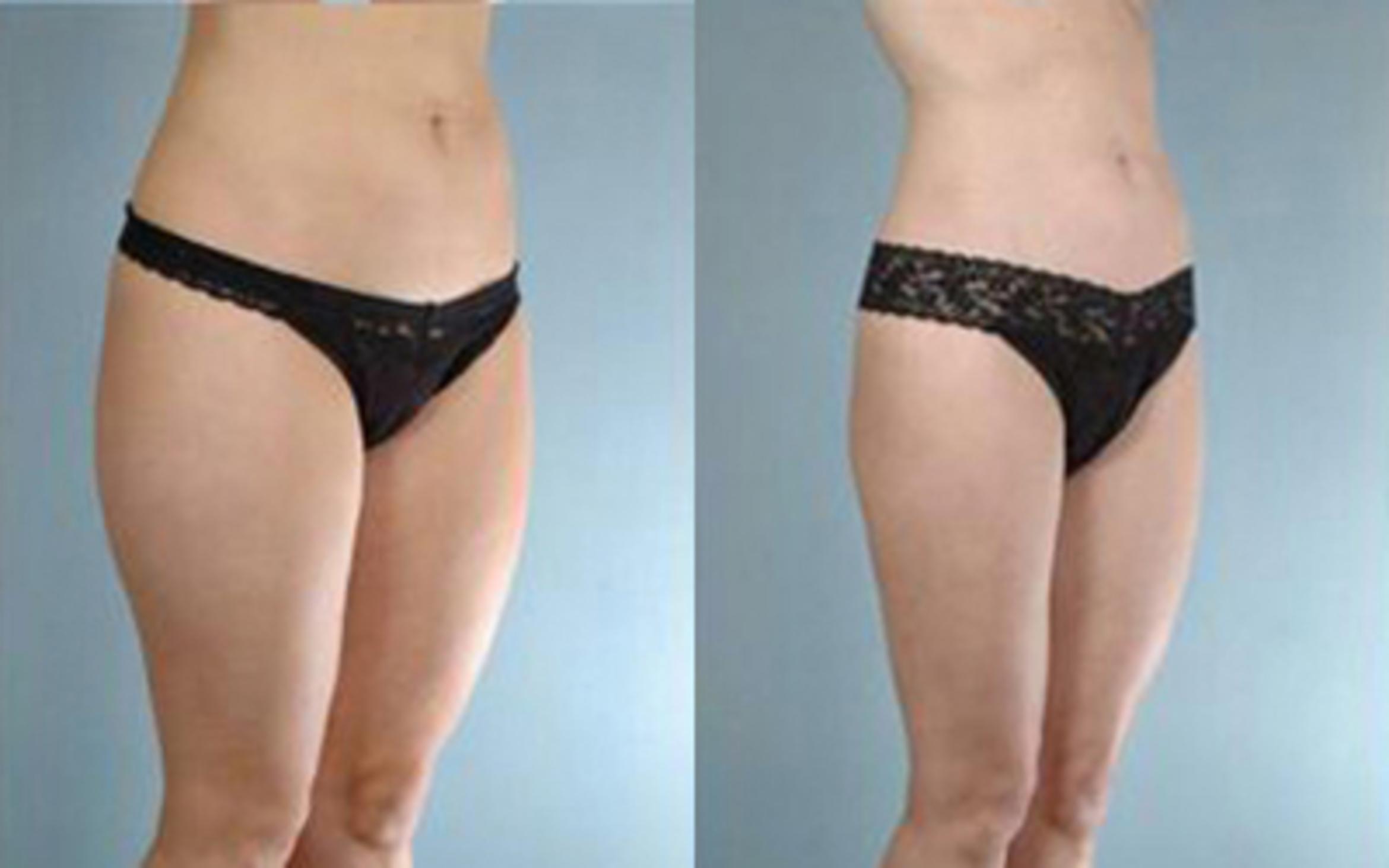 Before & After Liposuction Case 3215 View 2 View in Houston, TX