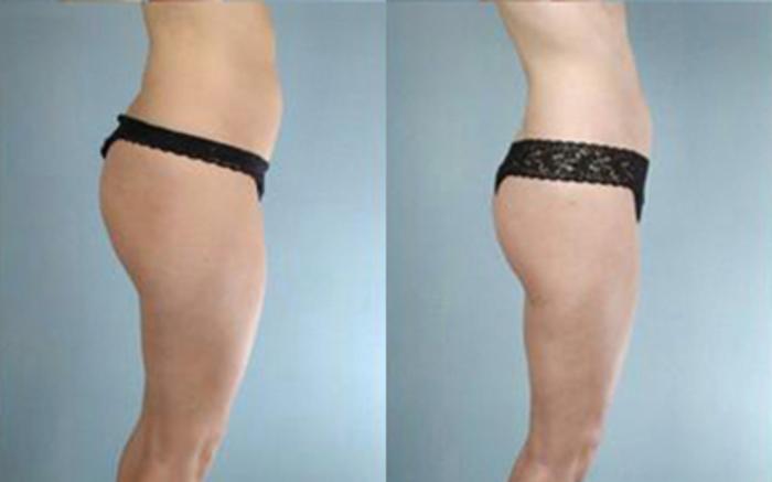 Before & After Liposuction Case 3215 View 3 View in Houston, TX