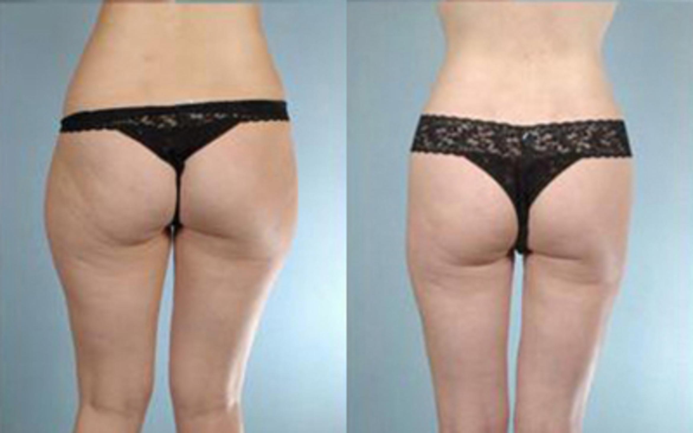 Before & After Liposuction Case 3215 View 4 View in Houston, TX
