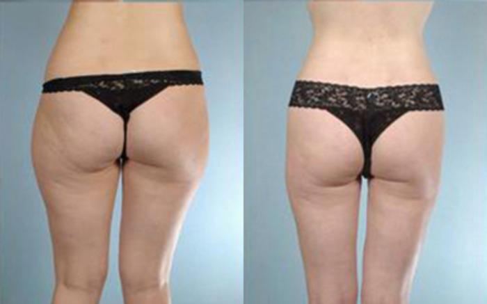 Before & After Liposuction Case 3215 View 4 View in Houston, TX