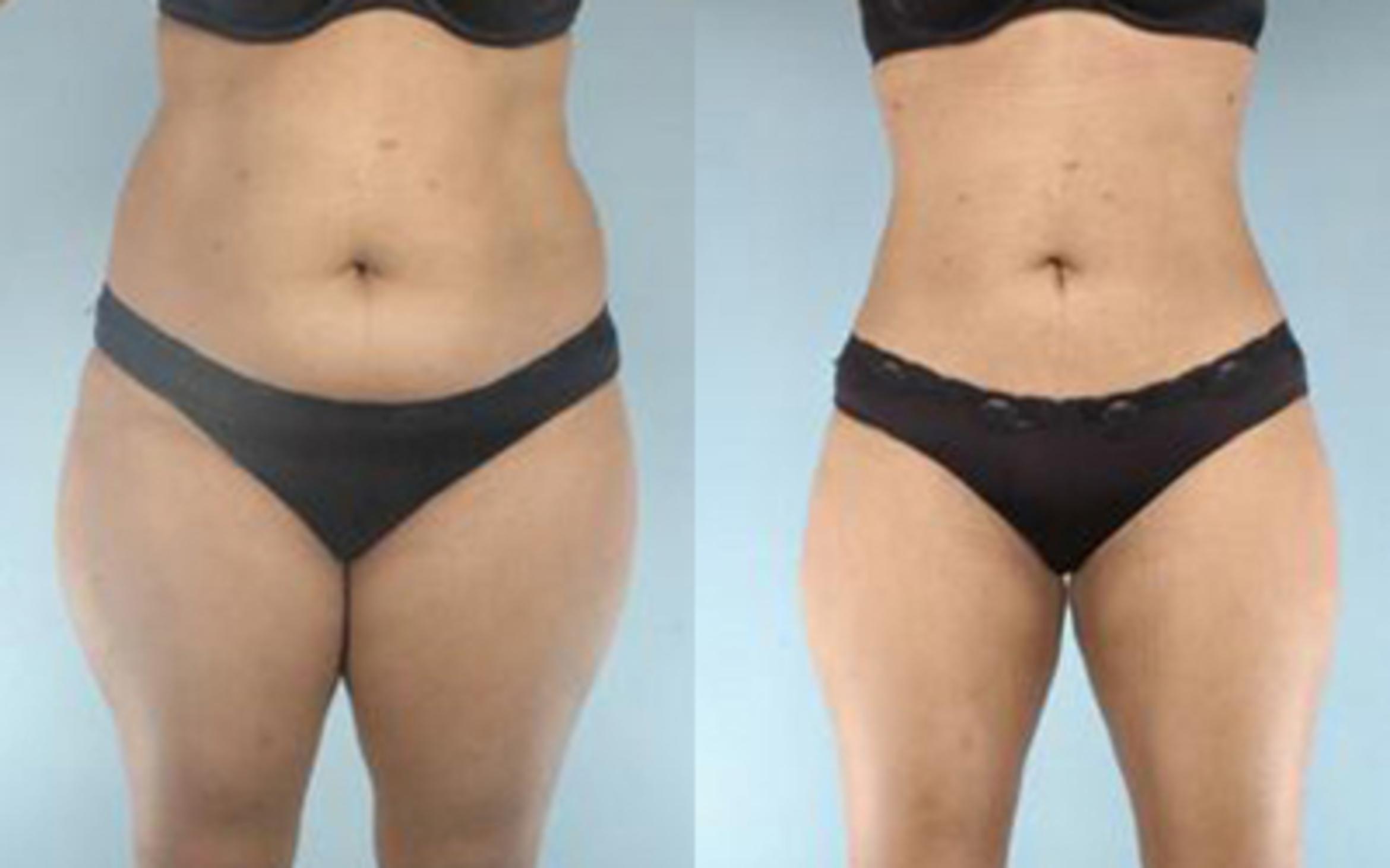 Before & After Liposuction Case 3225 View 1 View in Houston, TX