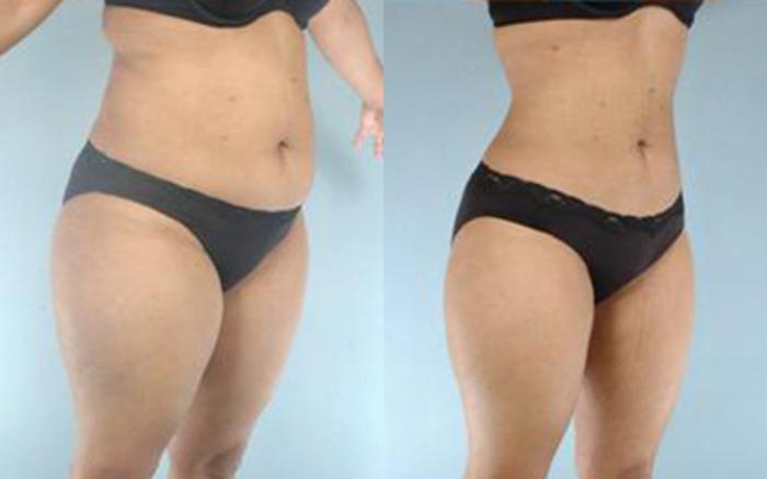 Before & After Liposuction Case 3225 View 2 View in Houston, TX
