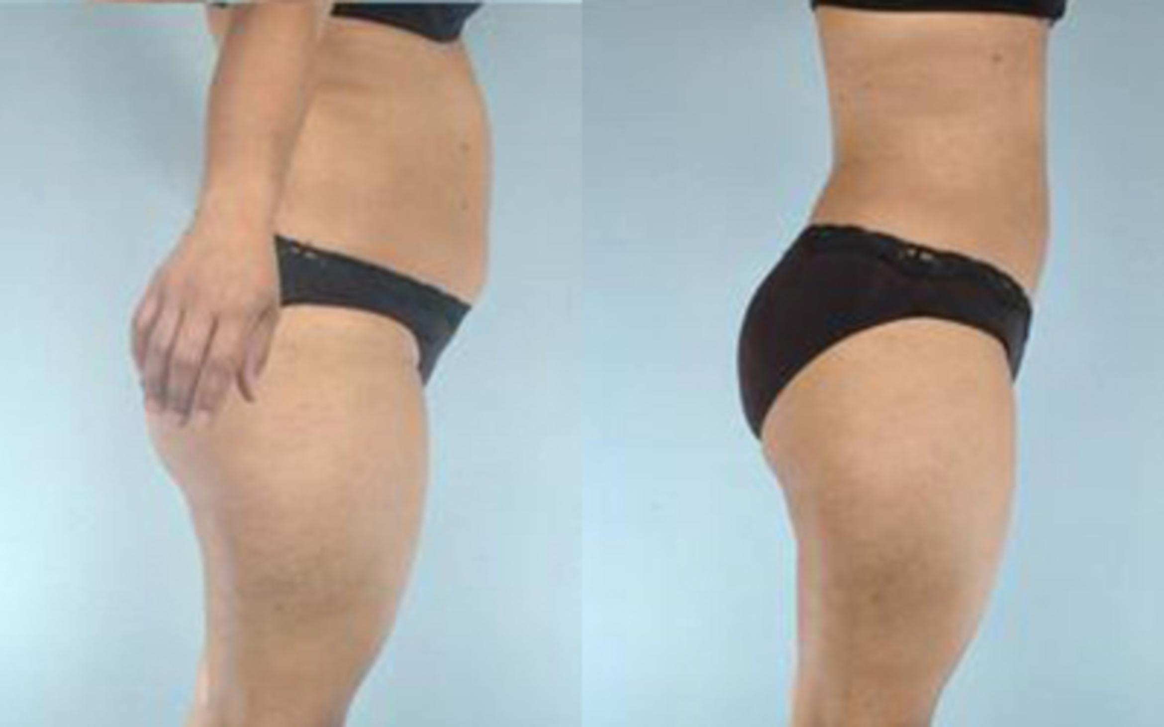 Before & After Liposuction Case 3225 View 3 View in Houston, TX