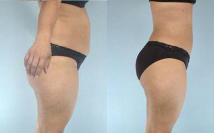 Before & After Liposuction Case 3225 View 3 View in Houston, TX