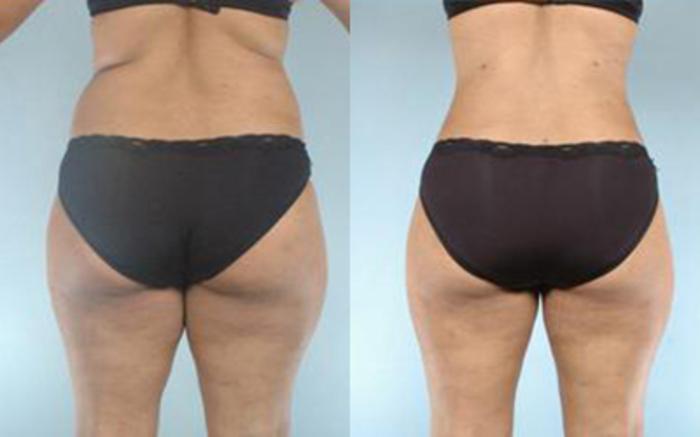 Before & After Liposuction Case 3225 View 4 View in Houston, TX