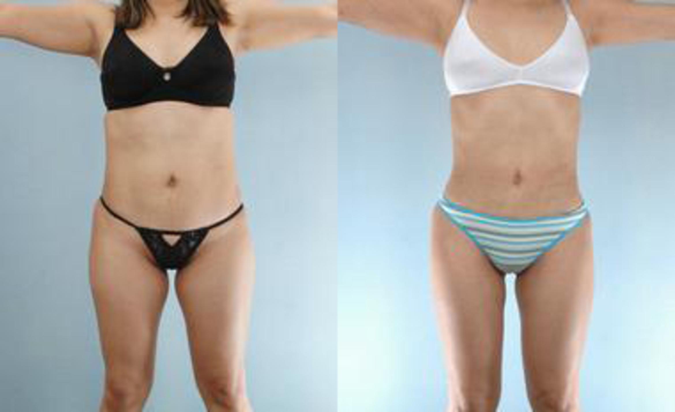 Before & After Liposuction Case 3235 View 1 View in Houston, TX