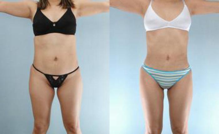 Before & After Liposuction Case 3235 View 1 View in Houston, TX