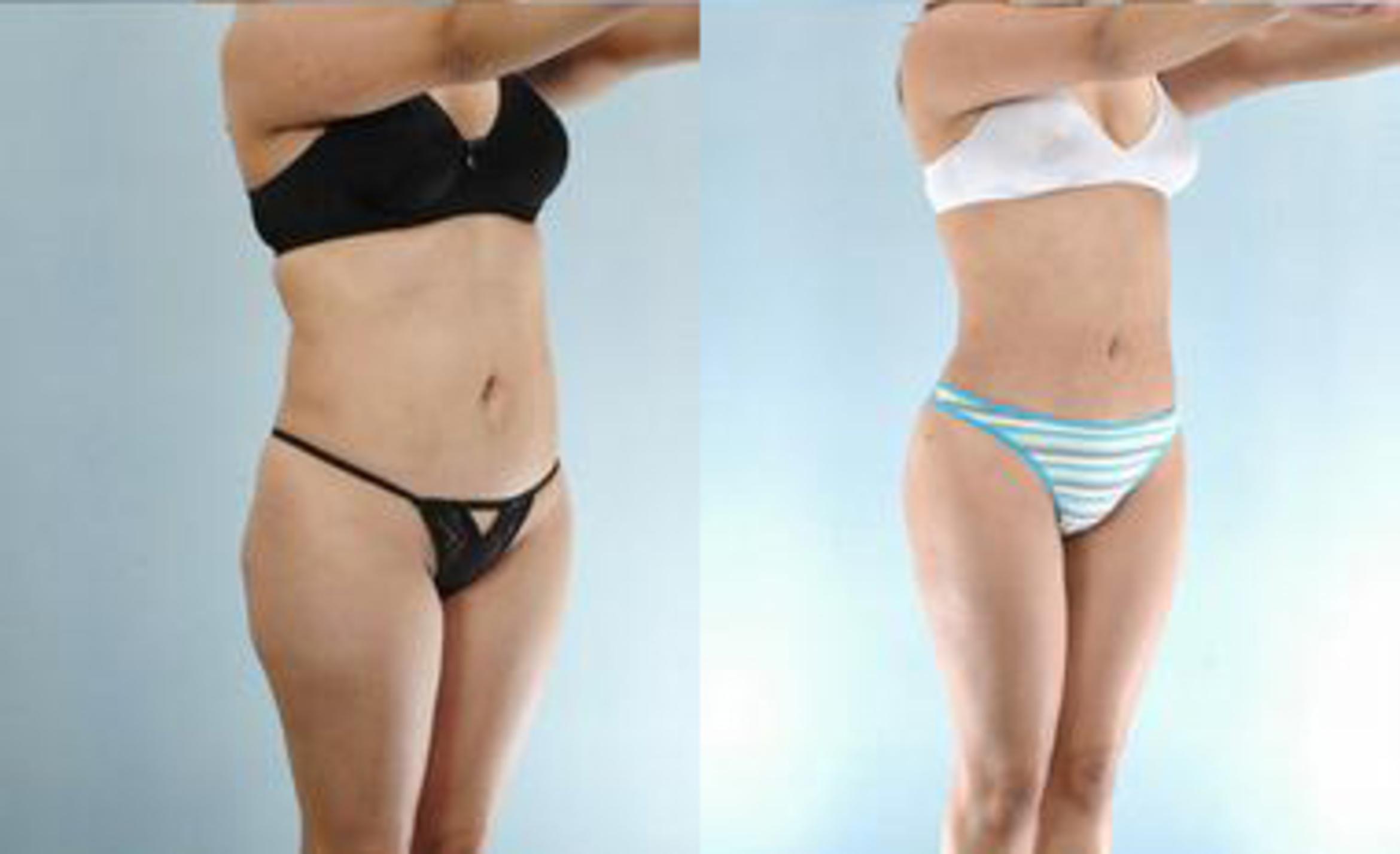 Before & After Liposuction Case 3235 View 2 View in Houston, TX