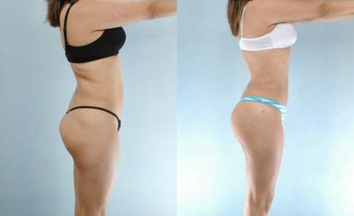 Before & After Liposuction Case 3235 View 3 View in Houston, TX