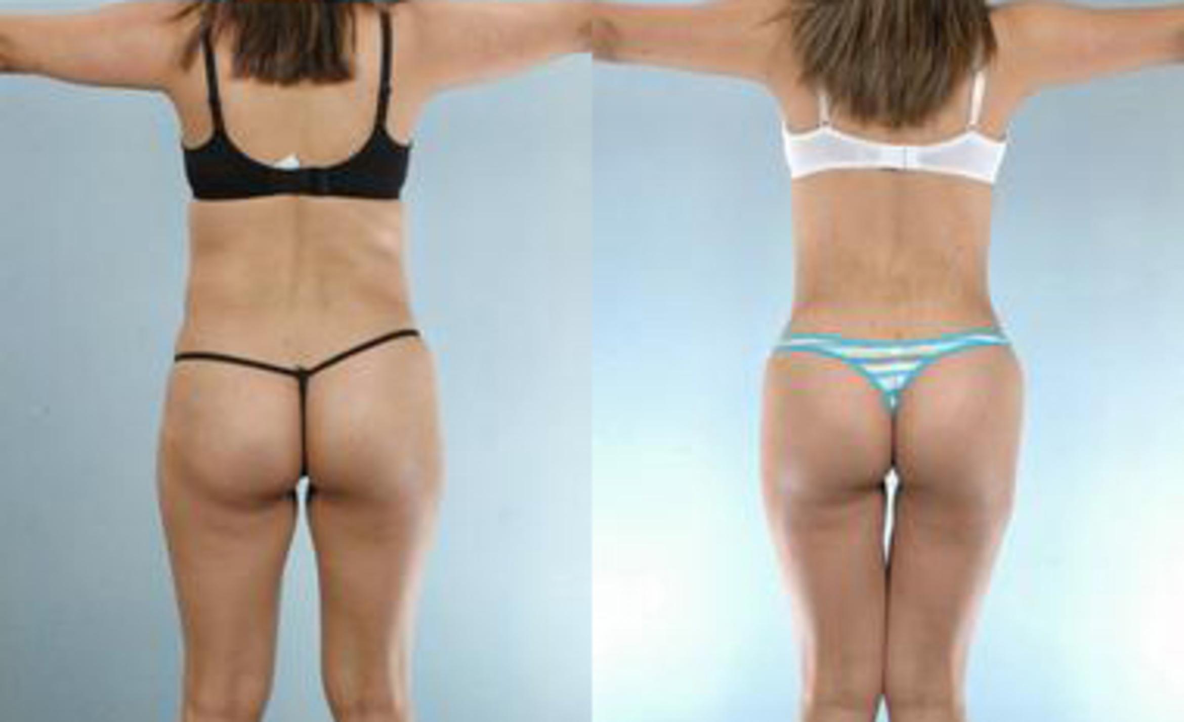 Before & After Liposuction Case 3235 View 4 View in Houston, TX