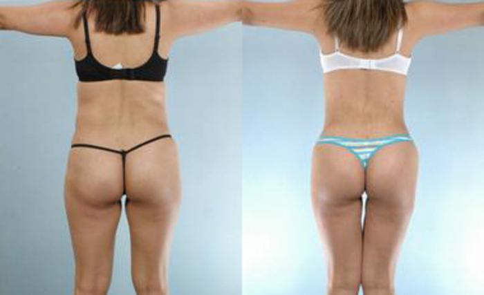 Before & After Liposuction Case 3235 View 4 View in Houston, TX