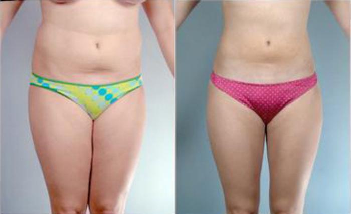Before & After Liposuction Case 3245 View 1 View in Houston, TX