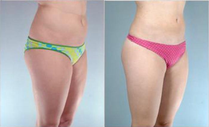 Before & After Liposuction Case 3245 View 2 View in Houston, TX