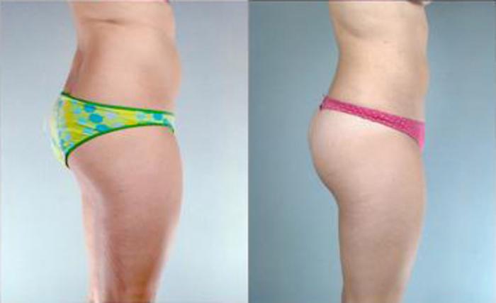 Before & After Liposuction Case 3245 View 3 View in Houston, TX