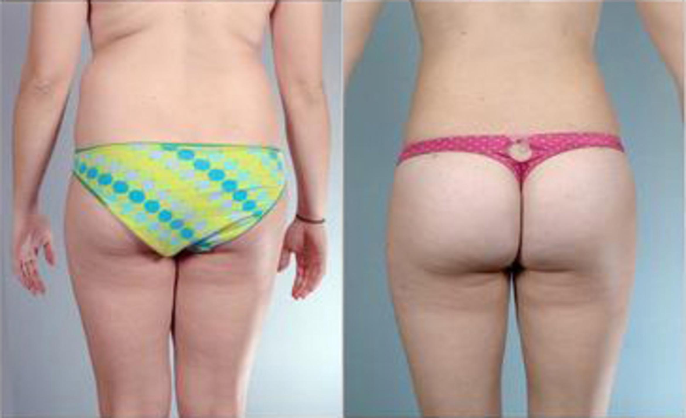 Before & After Liposuction Case 3245 View 4 View in Houston, TX