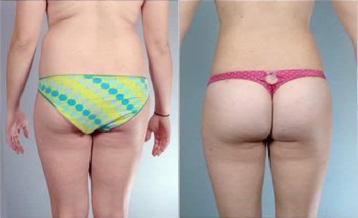 Before & After Liposuction Case 3245 View 4 View in Houston, TX