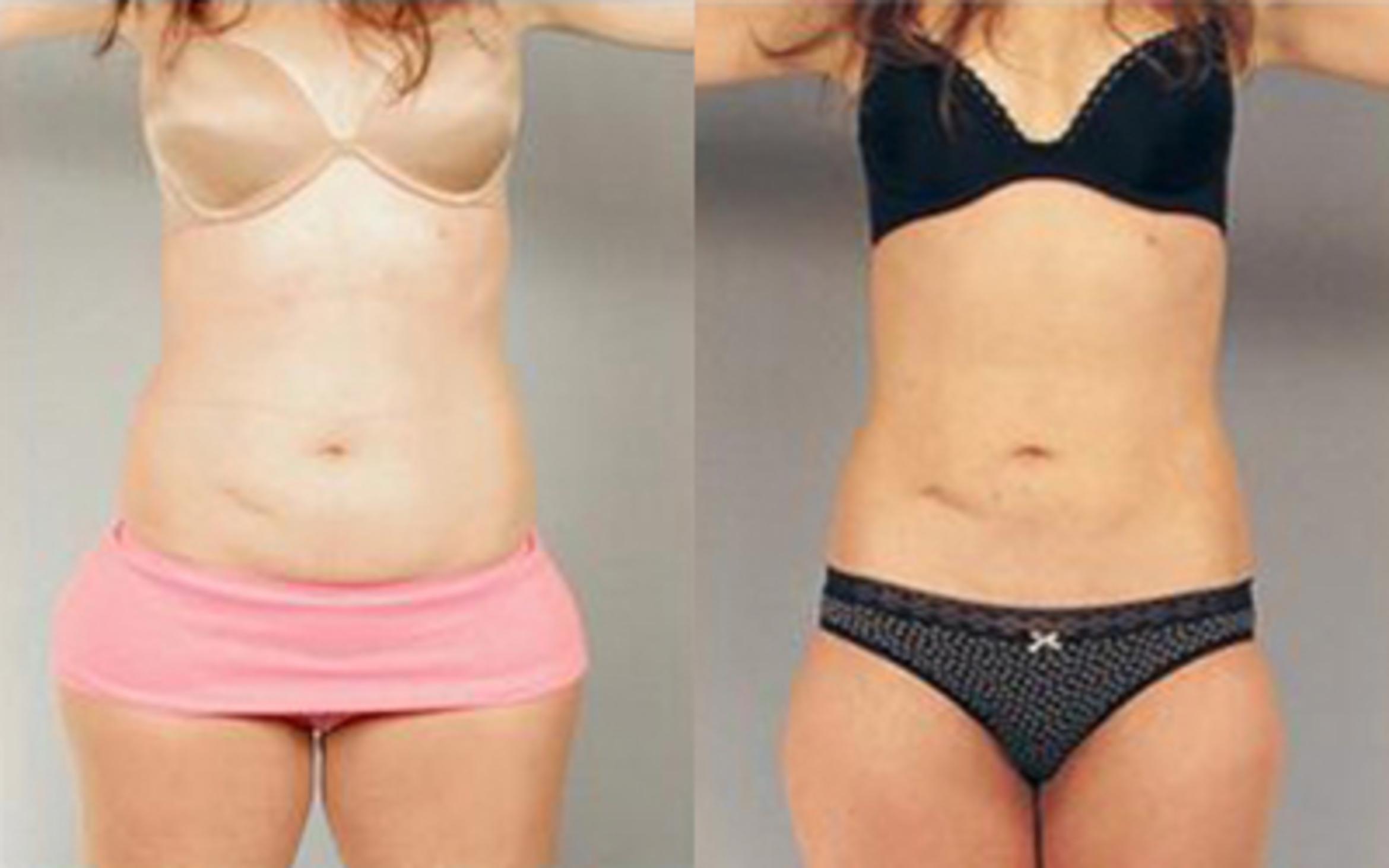 Before & After Liposuction Case 3255 View 1 View in Houston, TX