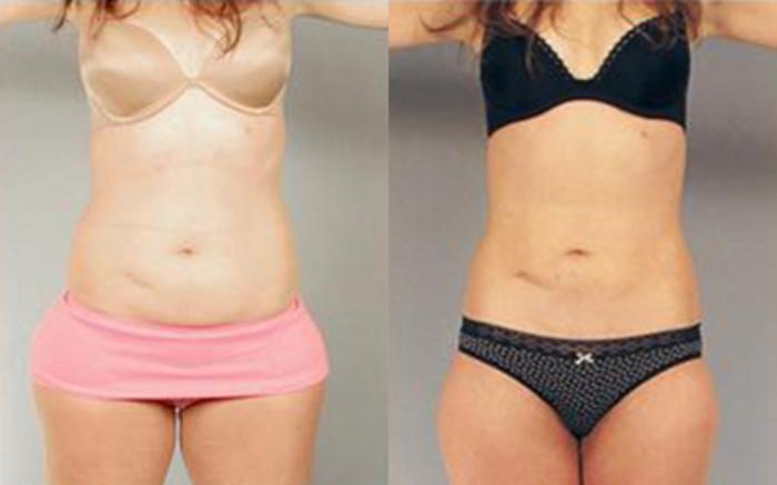 Before & After Liposuction Case 3255 View 1 View in Houston, TX