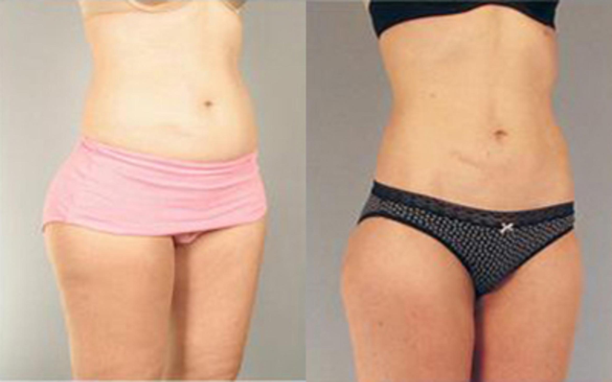 Before & After Liposuction Case 3255 View 2 View in Houston, TX
