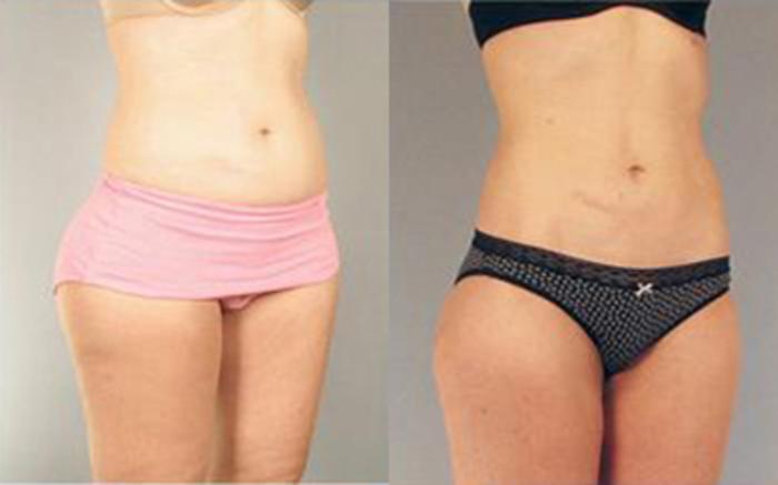 Before & After Liposuction Case 3255 View 2 View in Houston, TX