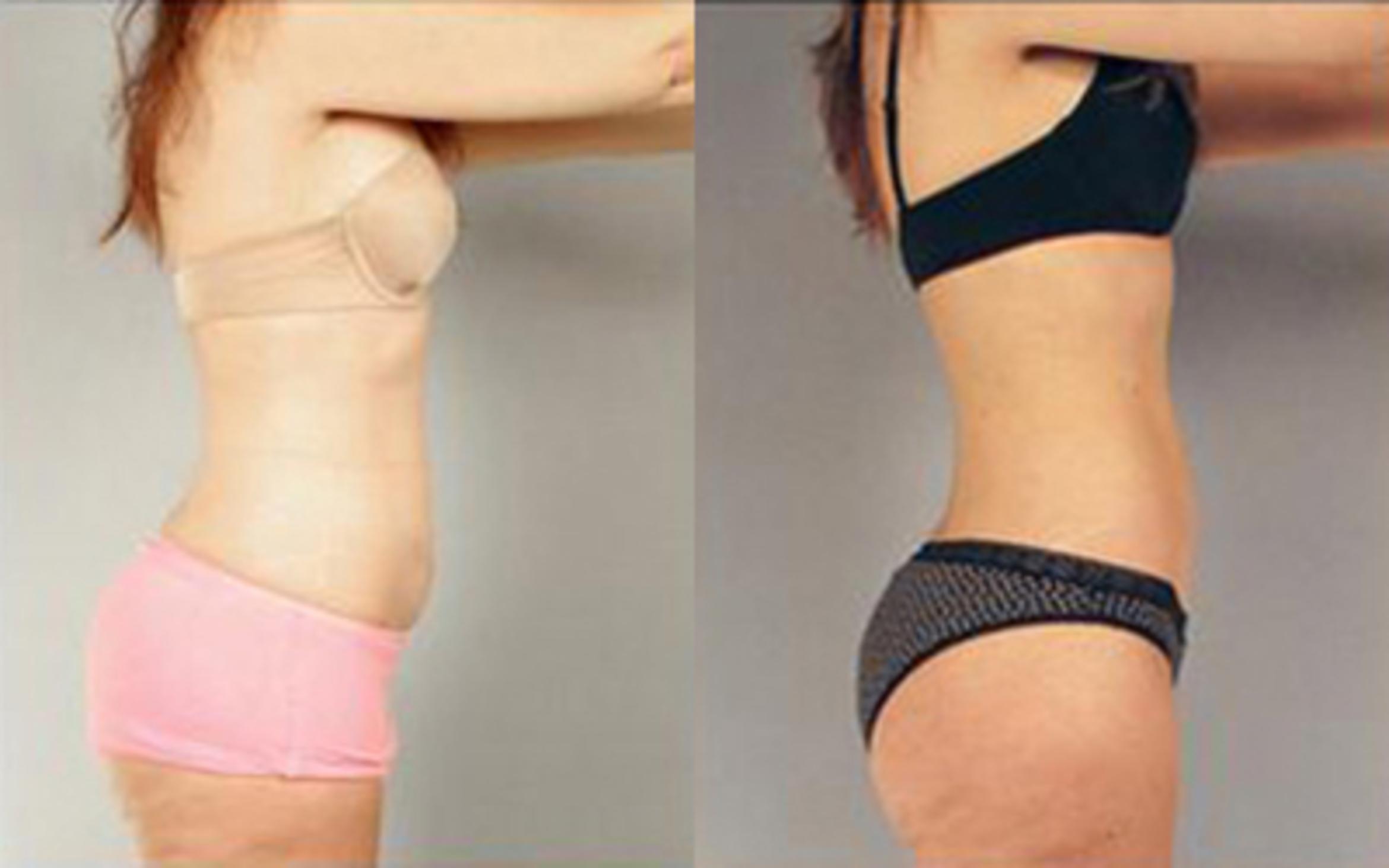 Before & After Liposuction Case 3255 View 3 View in Houston, TX