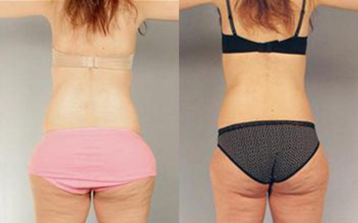 Before & After Liposuction Case 3255 View 4 View in Houston, TX