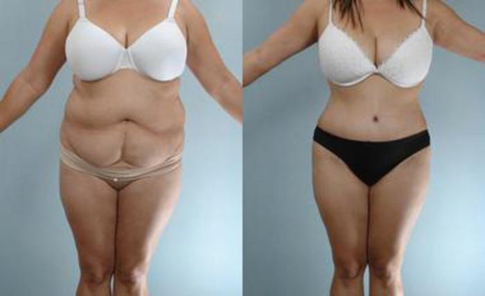 Before & After Liposuction Case 3265 View 1 View in Houston, TX