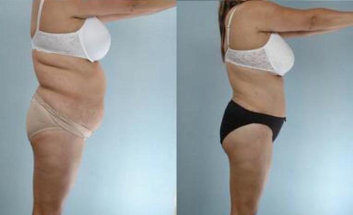 Before & After Liposuction Case 3265 View 3 View in Houston, TX