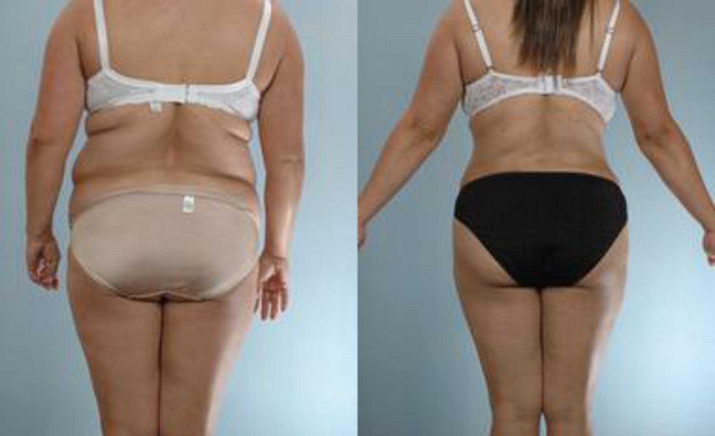 Before & After Liposuction Case 3265 View 4 View in Houston, TX