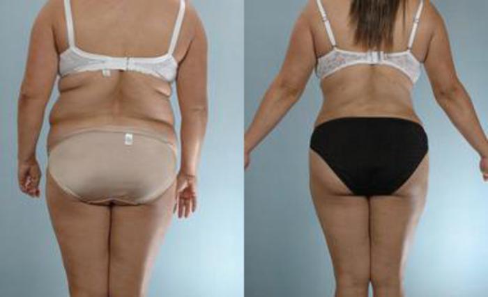 Before & After Liposuction Case 3265 View 4 View in Houston, TX