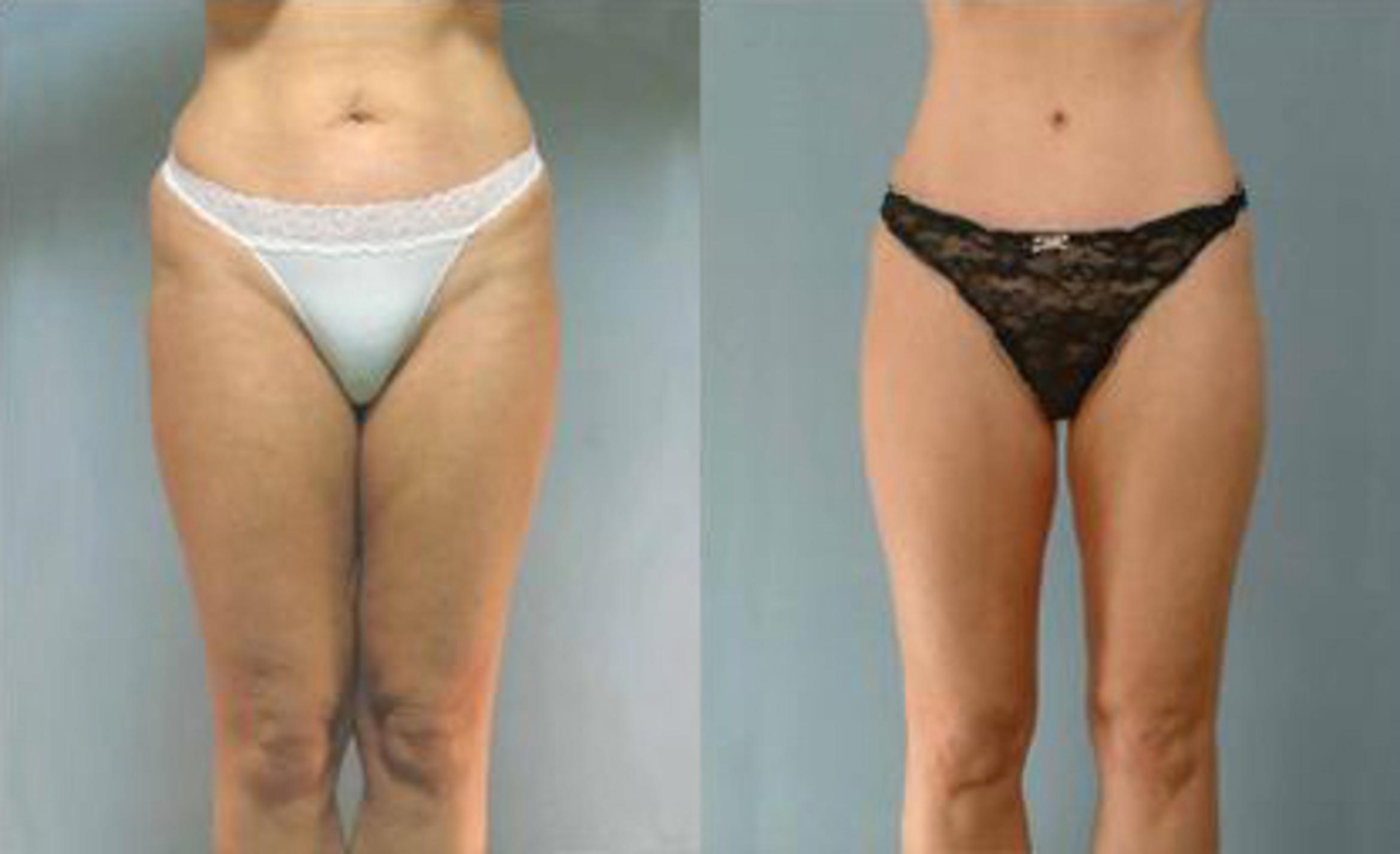 Before & After Liposuction Case 3275 View 1 View in Houston, TX