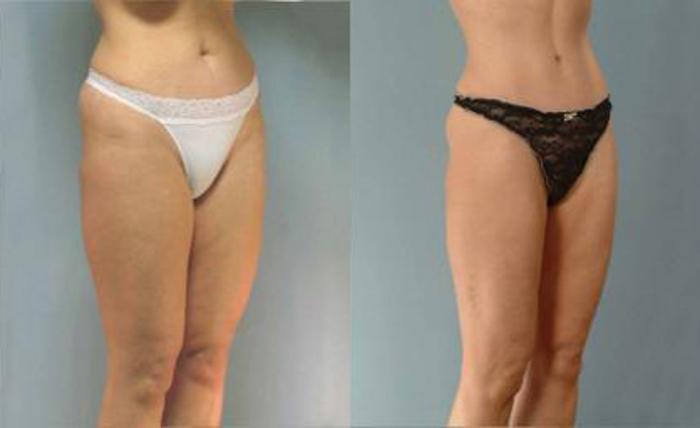 Before & After Liposuction Case 3275 View 2 View in Houston, TX