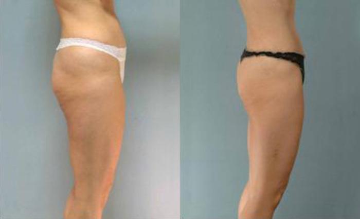 Before & After Liposuction Case 3275 View 3 View in Houston, TX
